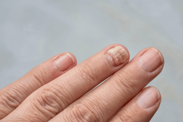 Dealing with Fungal Infections