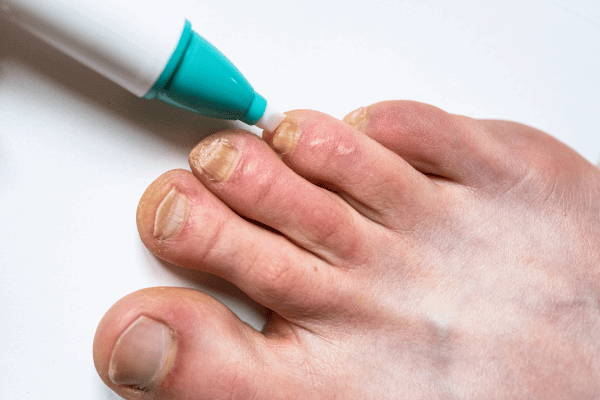 Fungal Nail Treatments