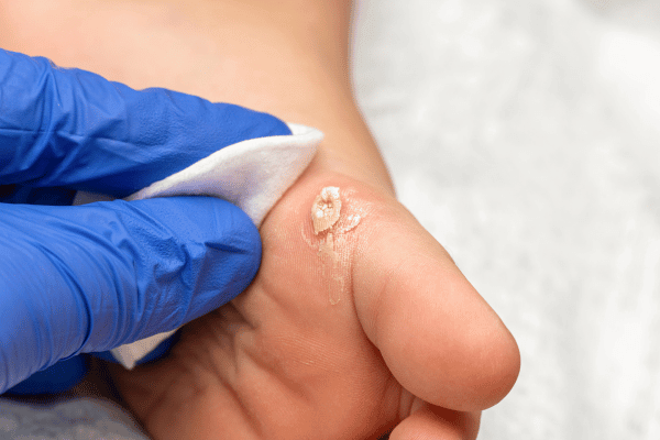 Preventing Corns and Calluses